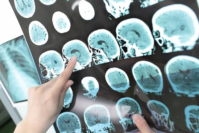 ‘Proyecto Múltiple’: el papel de la farmacia en la esclerosis múltiple ‘Proyecto Múltiple’: el papel de la farmacia en la esclerosis múltiple