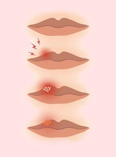 Consejos para tratar el herpes labial