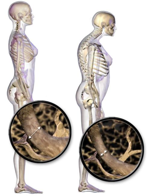 Paciente polimedicado con osteoporosis Paciente polimedicado con osteoporosis