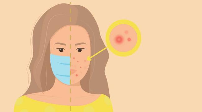 Cómo tratar el “maskné” desde la farmacia Cómo tratar el “maskné” desde la farmacia
